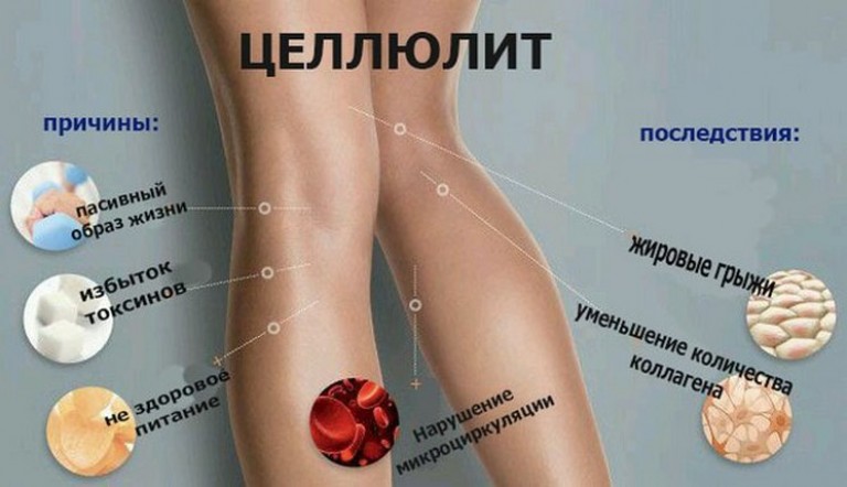 Целлюлит что это такое и почему появляется Целлюлит что это такое и почему появляется