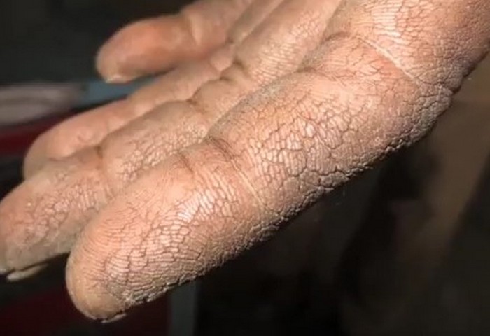 Как можно вылечить руки от трещин thumbnail