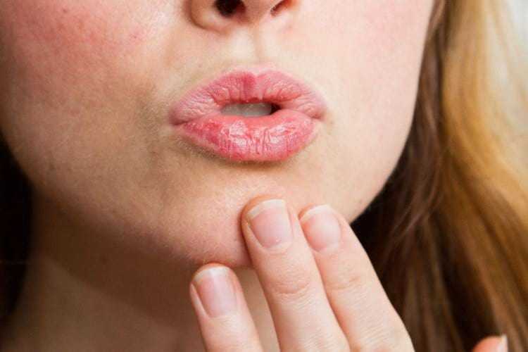 Как быстро вылечить обветренные губы