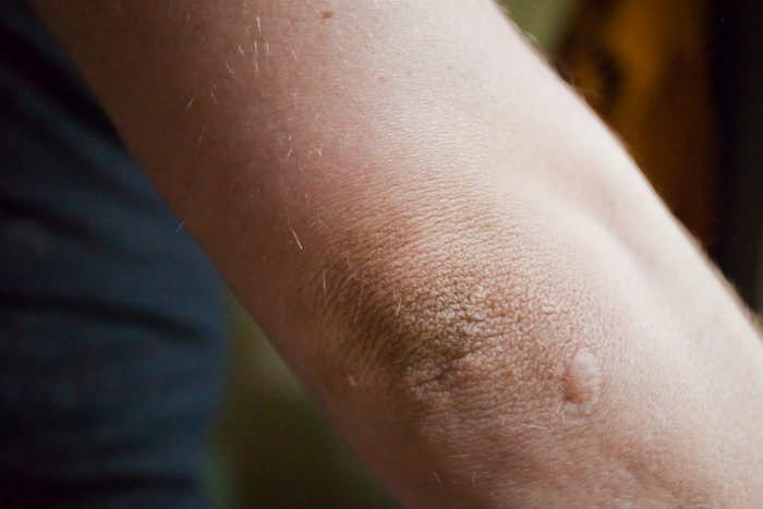 Почему на локтях сухая кожа: способы лечения сухих и шершавых локтей