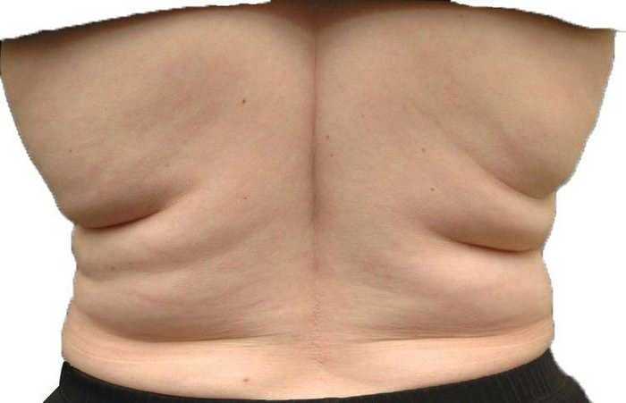 Как убрать жировые складки на спине: лучшие рекомендации